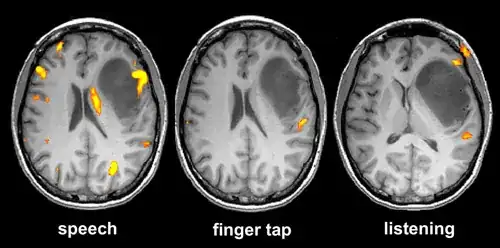 functional mri image